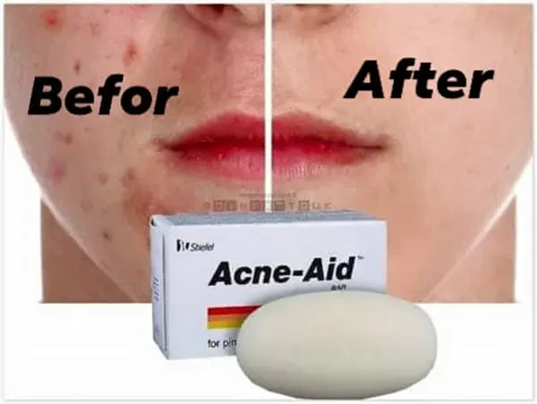 Stiefel Acne Aid Soap for Acne and Oily Skin-100gm 0